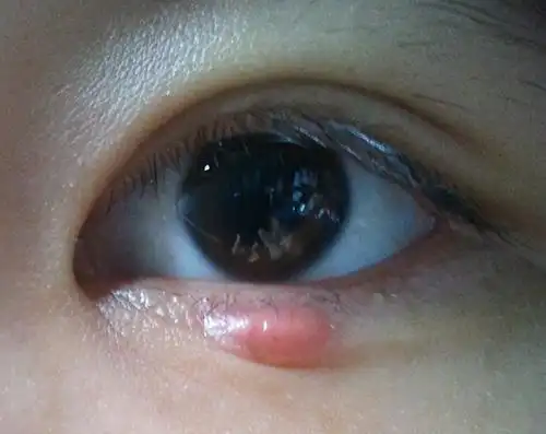 针眼图片_39健康网