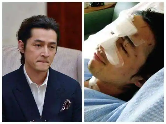 林志颖完成手部开刀,接下来是最重要的面部手术,有毁容的风险