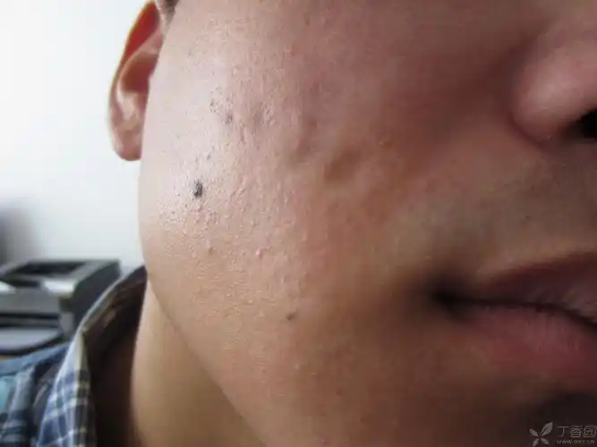 【病例讨论】面部萎缩性皮损-疑难讨论 - 皮肤与性传播疾病讨论版