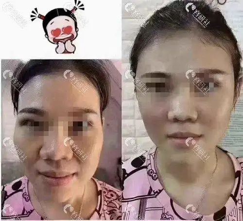 北京美莱医院做面部自体脂肪填充案例对比图