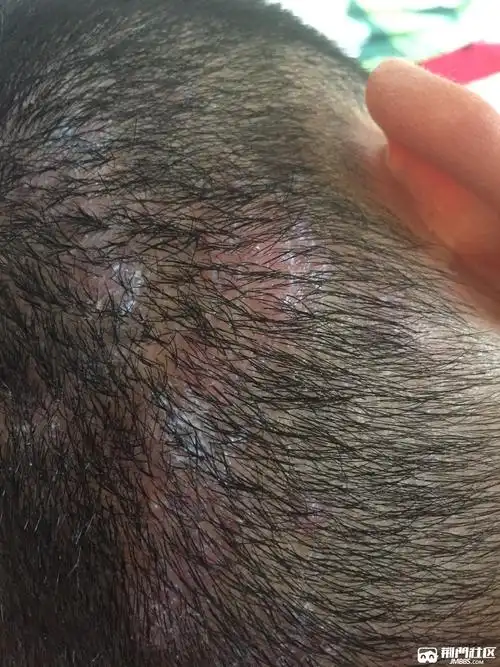 头部严重毛囊炎