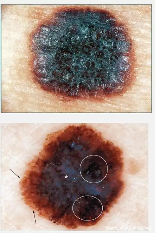 黑色素瘤的皮肤镜图像具有显著特征