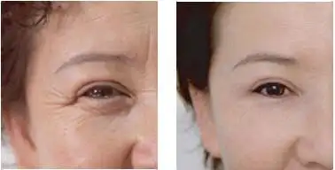 erf射频去眼纹前后对比