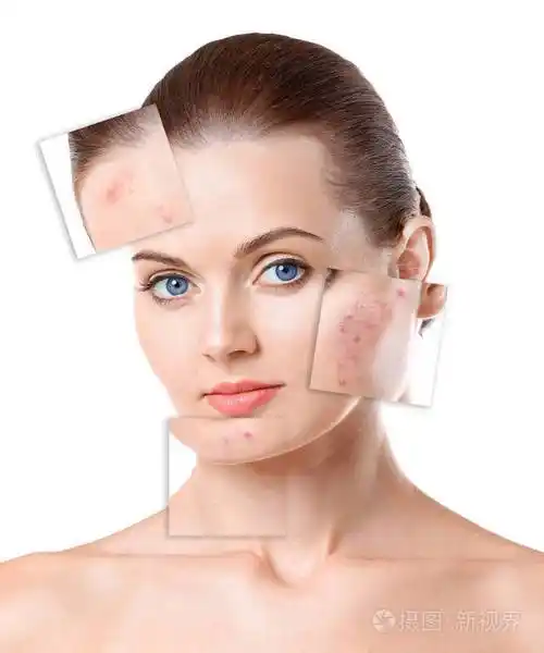 女性面部痤疮治疗前后的程序.护肤理念