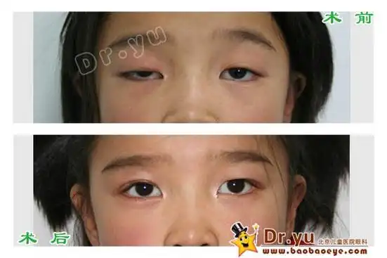 儿童上睑下垂手术前后照片集锦
