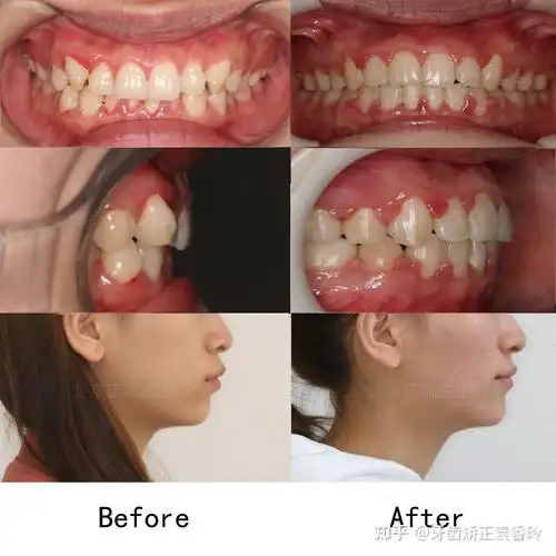 更可以改善牙齿的咬合关系,有利于牙齿和牙周的健康