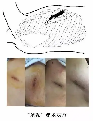 胸外科手术发展篇 - 从"开胸"到"开孔"_手机搜狐网