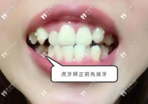 戴时代天使双模牙套矫正虎牙的过程就是痛并快乐着