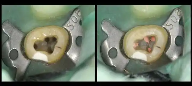 上颌第二磨牙4个根管病例