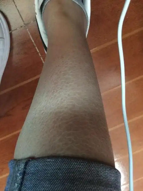 麻烦大家帮我看看我的腿部皮肤是干还是有皮肤病为什么看着和蛇皮一样