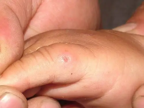 疥疮的病因有哪些?