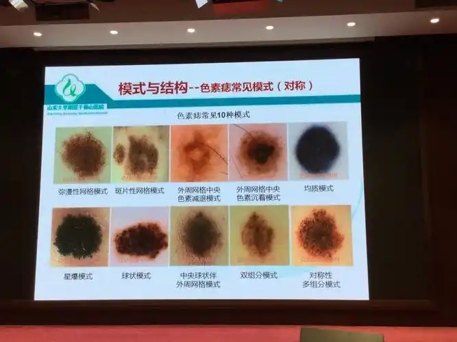 黑素细胞皮肤肿瘤皮肤镜鉴别特点及要点 辛琳琳教授