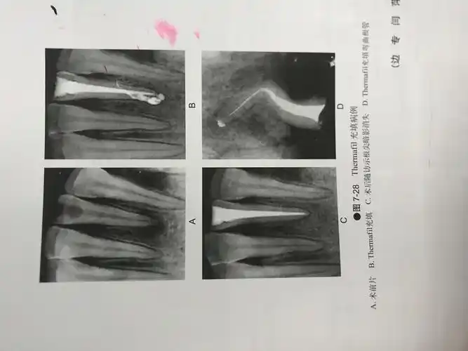 上颌第一磨牙根管治疗流程