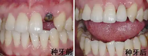 洛阳种植牙的价格 - 牙齿种植 - 洛阳维乐口腔医院-洛阳牙齿矫正医院-