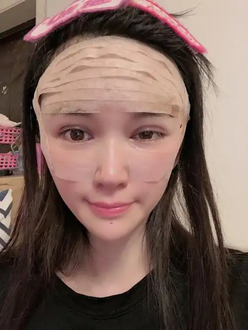 全脸脂肪胶填充算成功吧