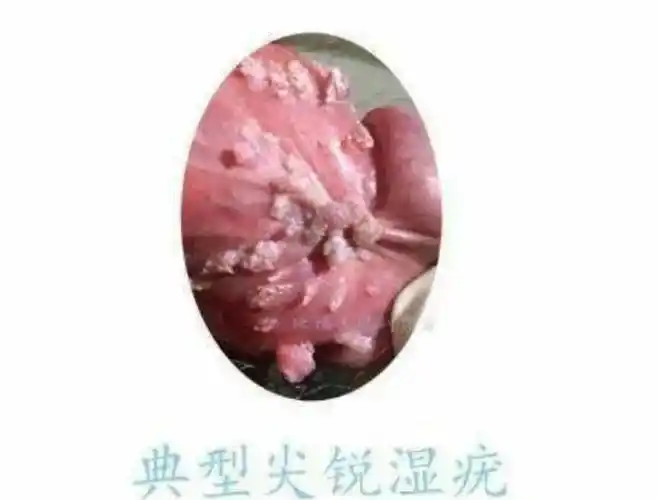 尖锐湿疣
