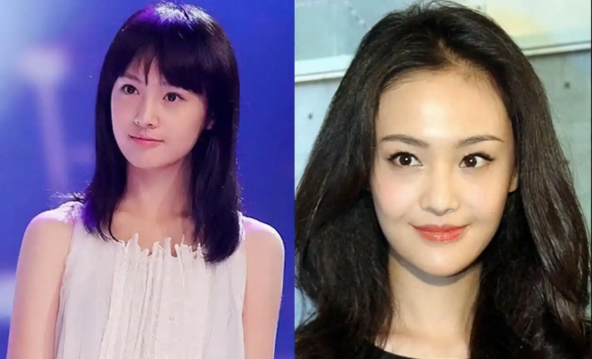 郑爽状态引热议!脸颊扭曲皱纹明显,发际线秃到头顶,整容失败?