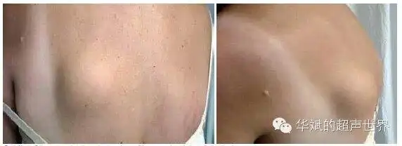 肩胛下弹力纤维瘤_软组织肿瘤_软组织肿瘤介绍 - 好大夫在线