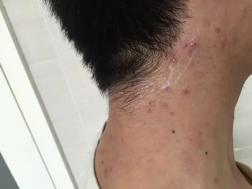 毛囊炎反复难愈求根治本人胸前颈部肩部和背部均长起了脓包