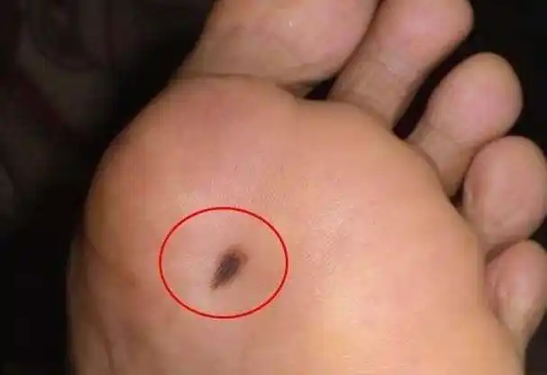脚侧边长了一个黑痣,脚侧面有痣需不需要处理-图片大观-奇异网