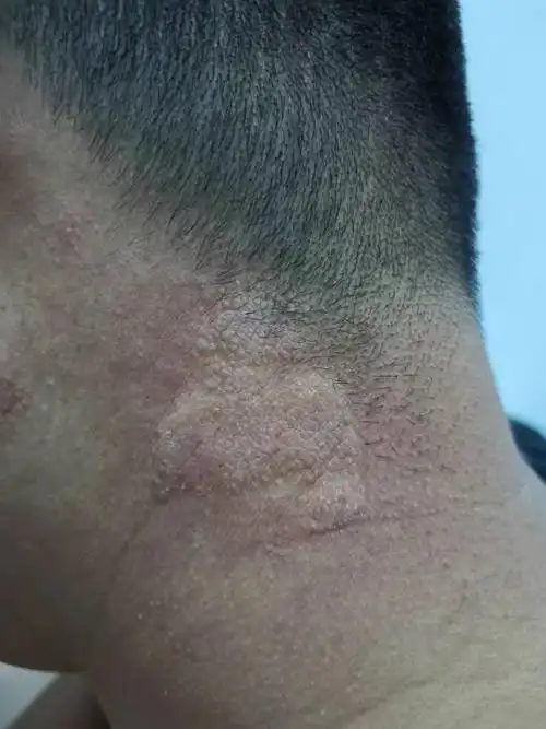 脖子上长的什么