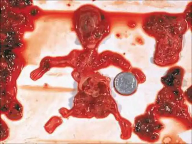 怀孕十几天流产图片_有来医生