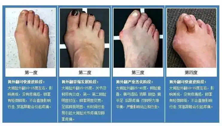 拇外翻的四个进行阶段