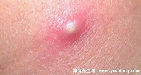 毛囊炎的症状和图片,针头大的红疹长成脓疱中央有毛发贯穿