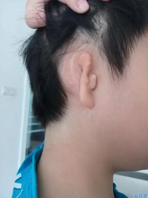 求助万能淘股吧耳朵畸形整形的名医或做整形的权威医院