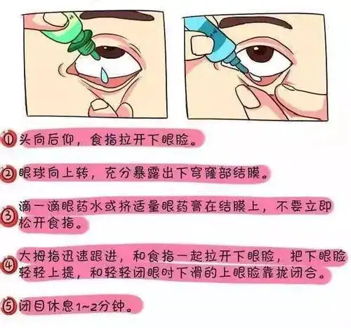 眼部感染,例如 角膜炎, 结膜炎等,主要的方法就是一次滴入眼睑内1~2滴