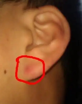 耳垂里面长了个硬疙瘩是怎么回事是肿瘤吗怎么治疗