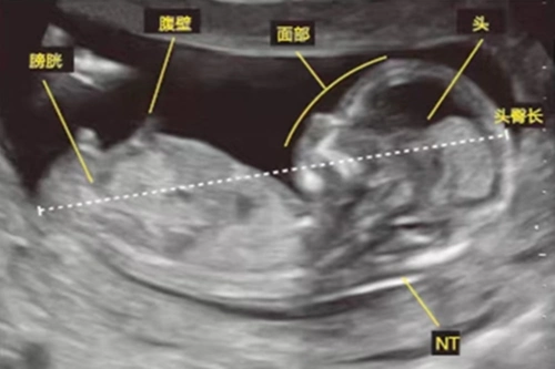 她们所指的是胎儿宝宝的脊柱发育情况,难道真的如她们所证实的一样吗?