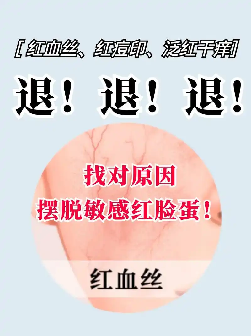 正确认识红血丝7215 告别红脸蛋92.