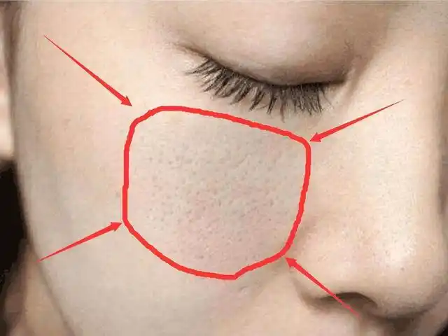 脸上的"大毛孔"该怎么去除?今天过来人教你一个合理的解决方案