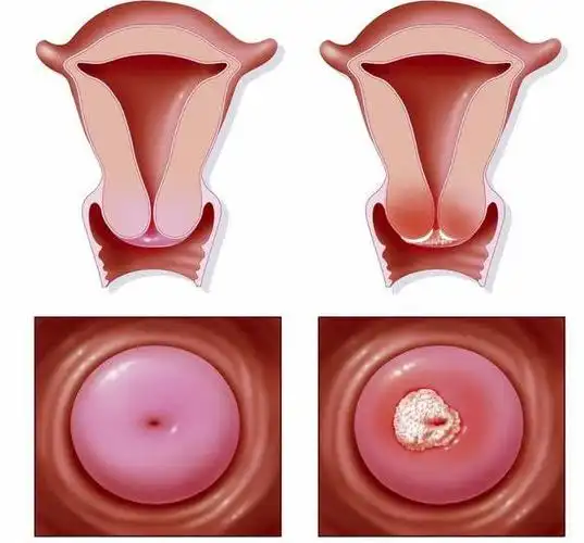 妇科炎症医生告诉你为啥不能大意