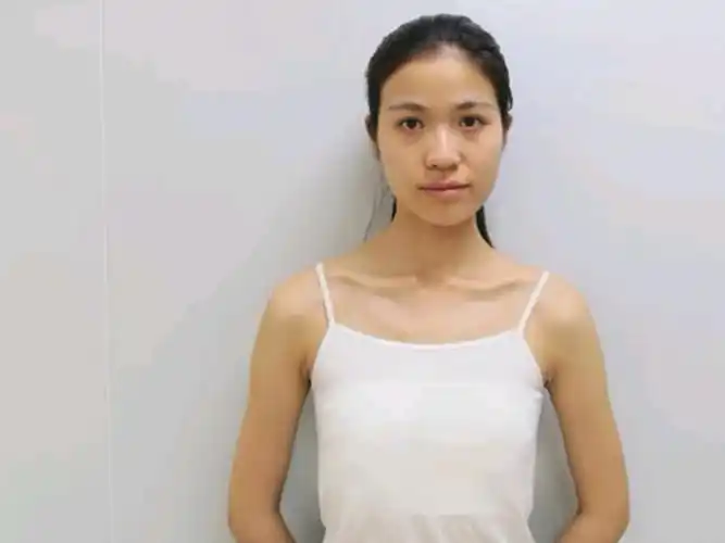 【沈阳茗湲假体丰胸32天】隆胸做完1个月了,平胸妹_圈子-新氧美容整形