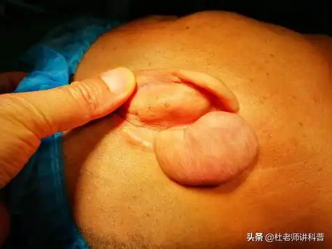 你好:导致阴囊上面有疙瘩这种现象的原因有很多,一般病理性原因造成的