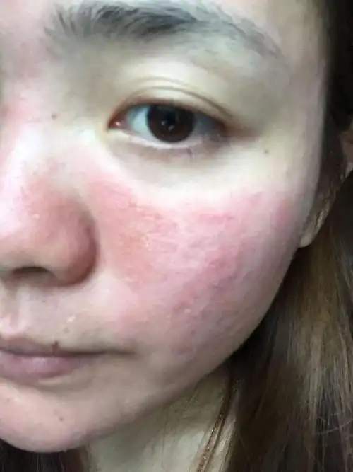 问题皮肤之"激素脸"