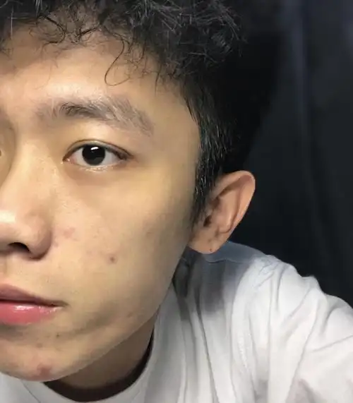 男生皮肤粗糙,脸上有痘,毛孔粗大如何护肤?