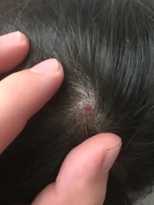 头皮上长了个疙瘩红色的