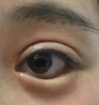 右眼睛的下眼睑一直跳(右眼睛的下眼睑一直跳怎么回事)