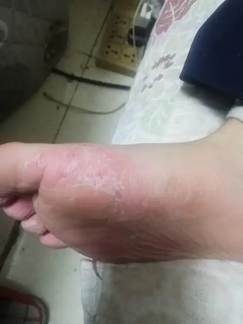 真菌感染|病毒性皮炎|湿疹|毛囊炎|廯|冻疮|烧烫伤|过敏性皮炎|日光性