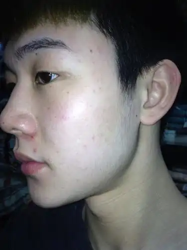 本人男 20岁 皮肤很敏感,动不动就过敏,吃药没效果 好几天了都没好转