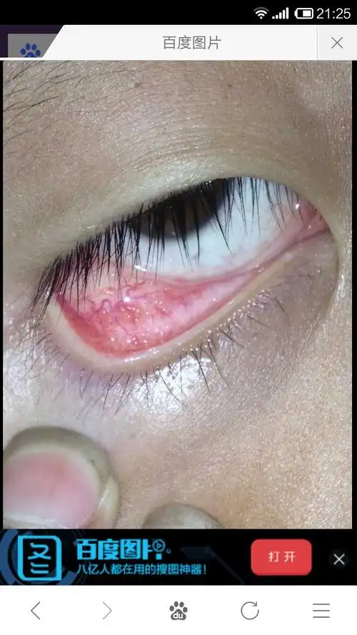 小孩下眼皮里面有很多似小水疱的小疙瘩,有点痒是怎麽回事