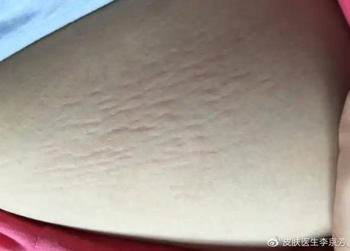 她主要是受女性怀孕荷尔蒙影响,加之腹部急剧膨隆,使皮肤的弹力纤维与