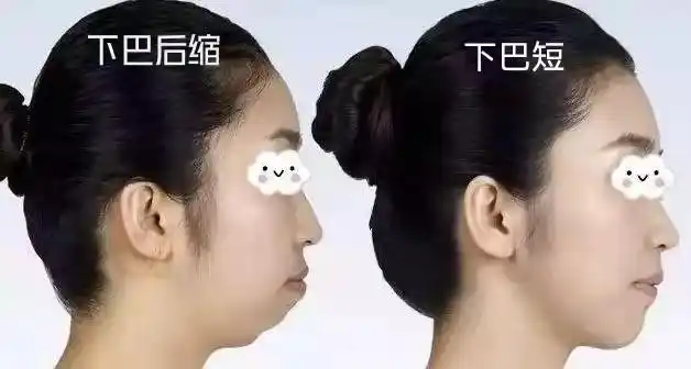 下巴后缩怎么改善做玻尿酸还是假体效果会更好