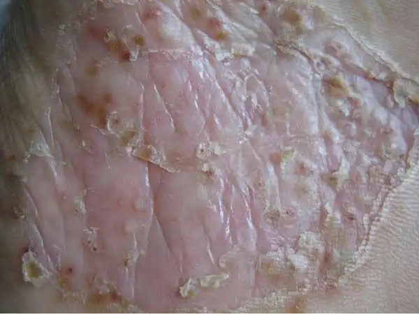 脸上有块白色的癣图片