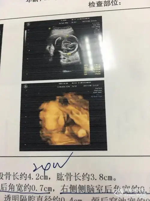 宝可能性大长和宽相等女宝宝可能性大四维照片一看就是男孩其二看形状