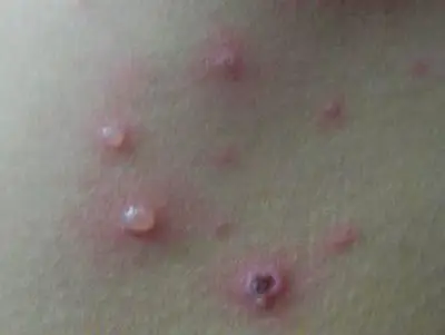 妈妈注意孩子生水痘能不能揉眼睛