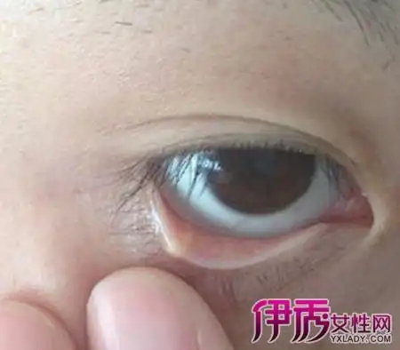 下眼睑长了麦粒肿图片反馈 告诉你3个治疗此炎症的好方法_伊秀健康